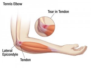 tennis elbow